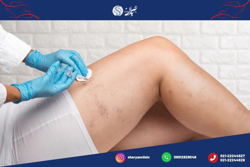 موارد کاربرد اسکلروتراپی