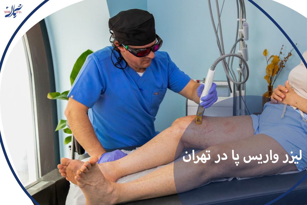 لیزر واریس پا در تهران
