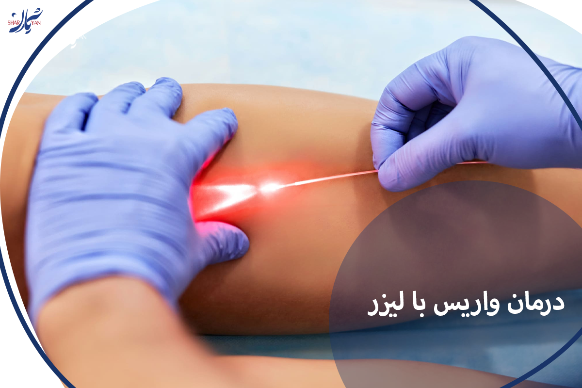 درمان واریس با لیزر