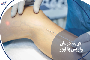 هزینه درمان واریس با لیزر