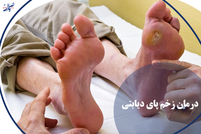 درمان زخم پای دیابتی