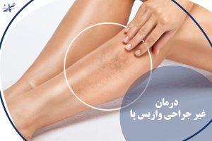 درمان غیر جراحی واریس پا