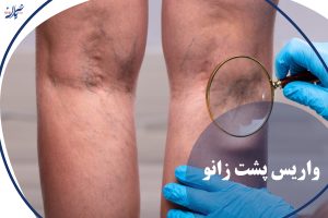 واریس پشت زانو
