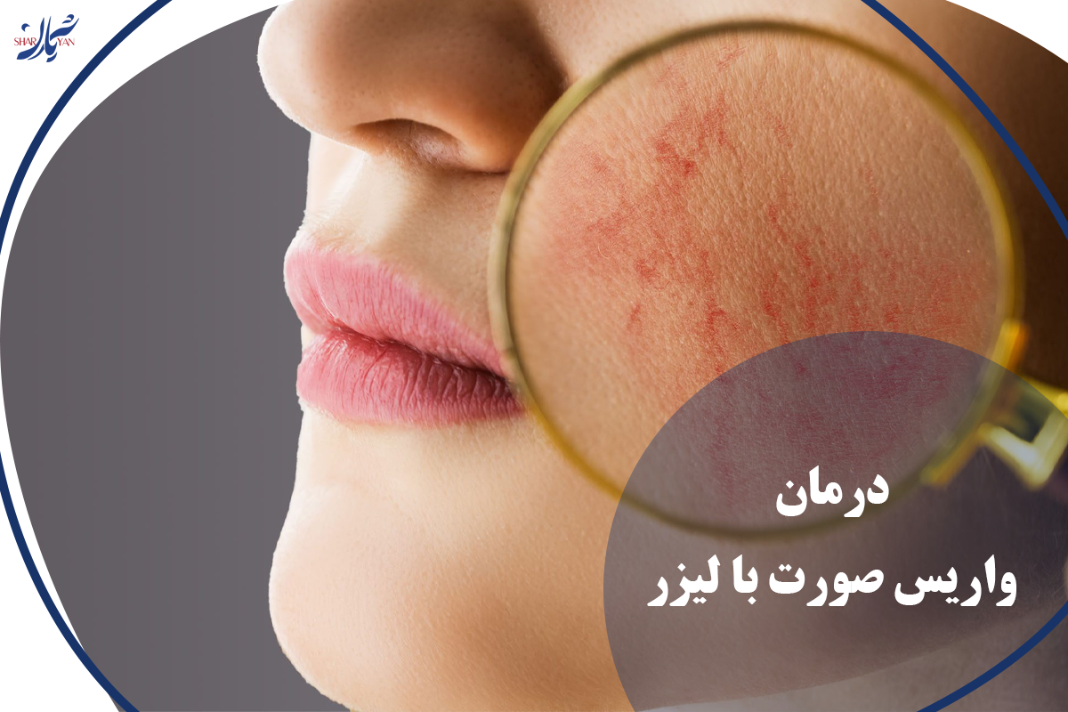 درمان واریس صورت با لیزر