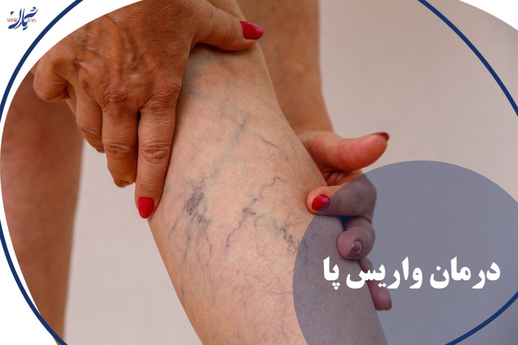 واریس پا