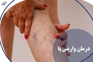 واریس پا