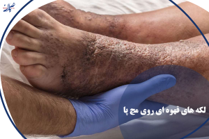 لکه‌ های قهوه‌ ای روی مچ پا