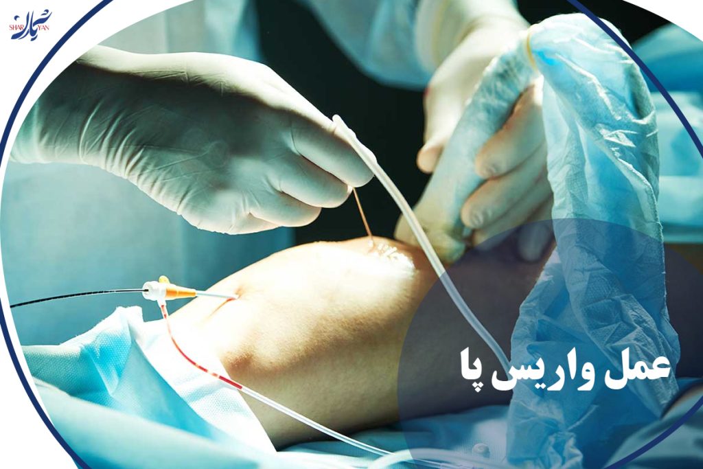 عمل واریس پا