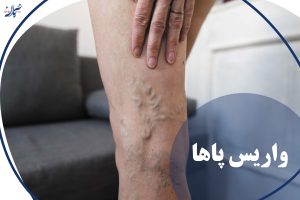 واریس پاها