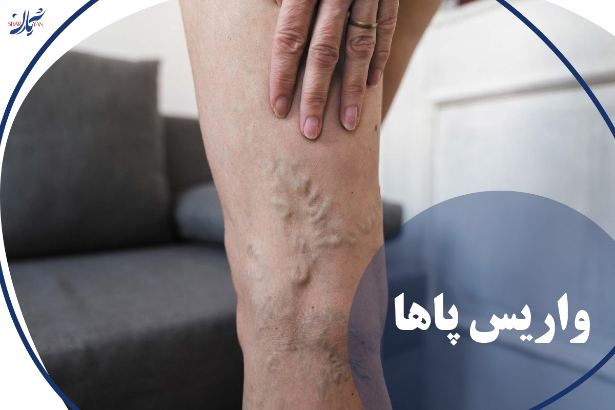 واریس پاها